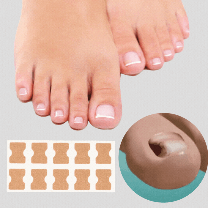 Last Day 50% OFF | PediPatch™ Nail Correction Patches (100 pieces)