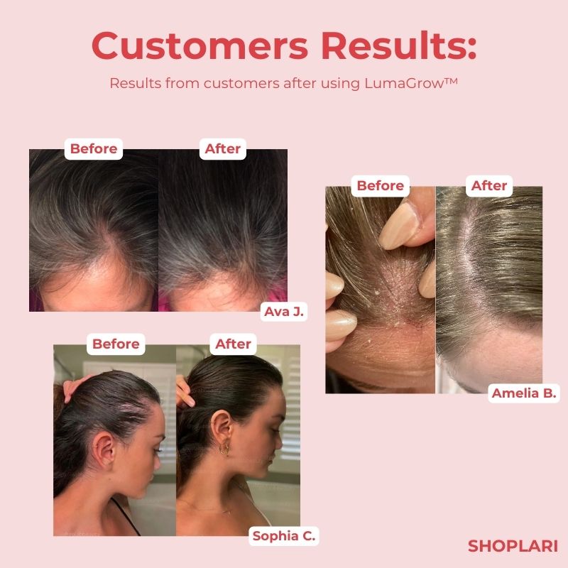50% OFF🔥 I LumaGrow™ Scalp Massager