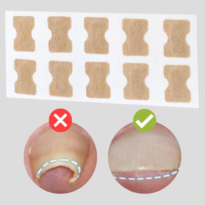 Last Day 50% OFF | PediPatch™ Nail Correction Patches (100 pieces)