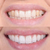 50% OFF🔥 I GlowDent™ Teeth Whitening Pen