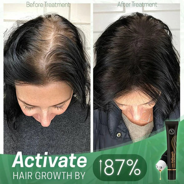 FollicaGrow™ Hair Serum Roller