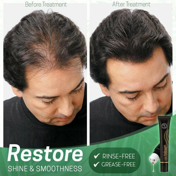 FollicaGrow™ Hair Serum Roller