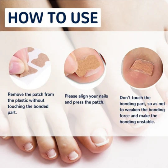 Last Day 50% OFF | PediPatch™ Nail Correction Patches (100 pieces)